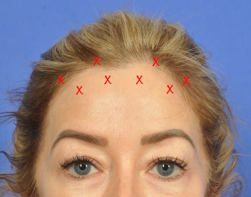 Woman's Face with Botox Injection Sites Marked with Red x's