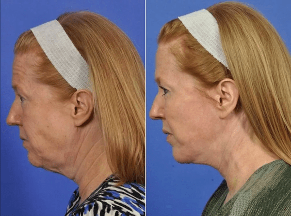 Before and after image showing the results of a facelift performed by Dr. Wulc.